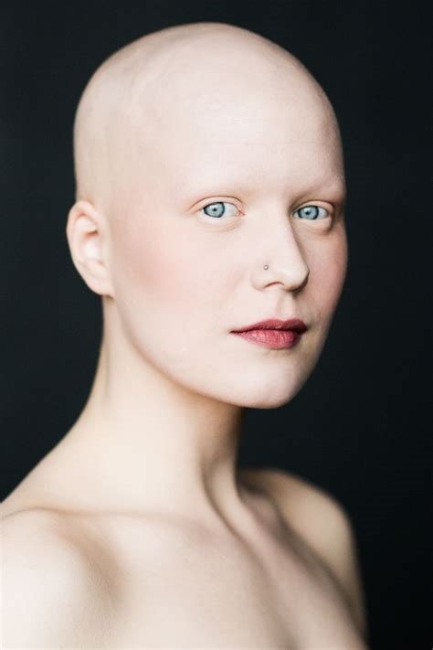 alopecia porn nude